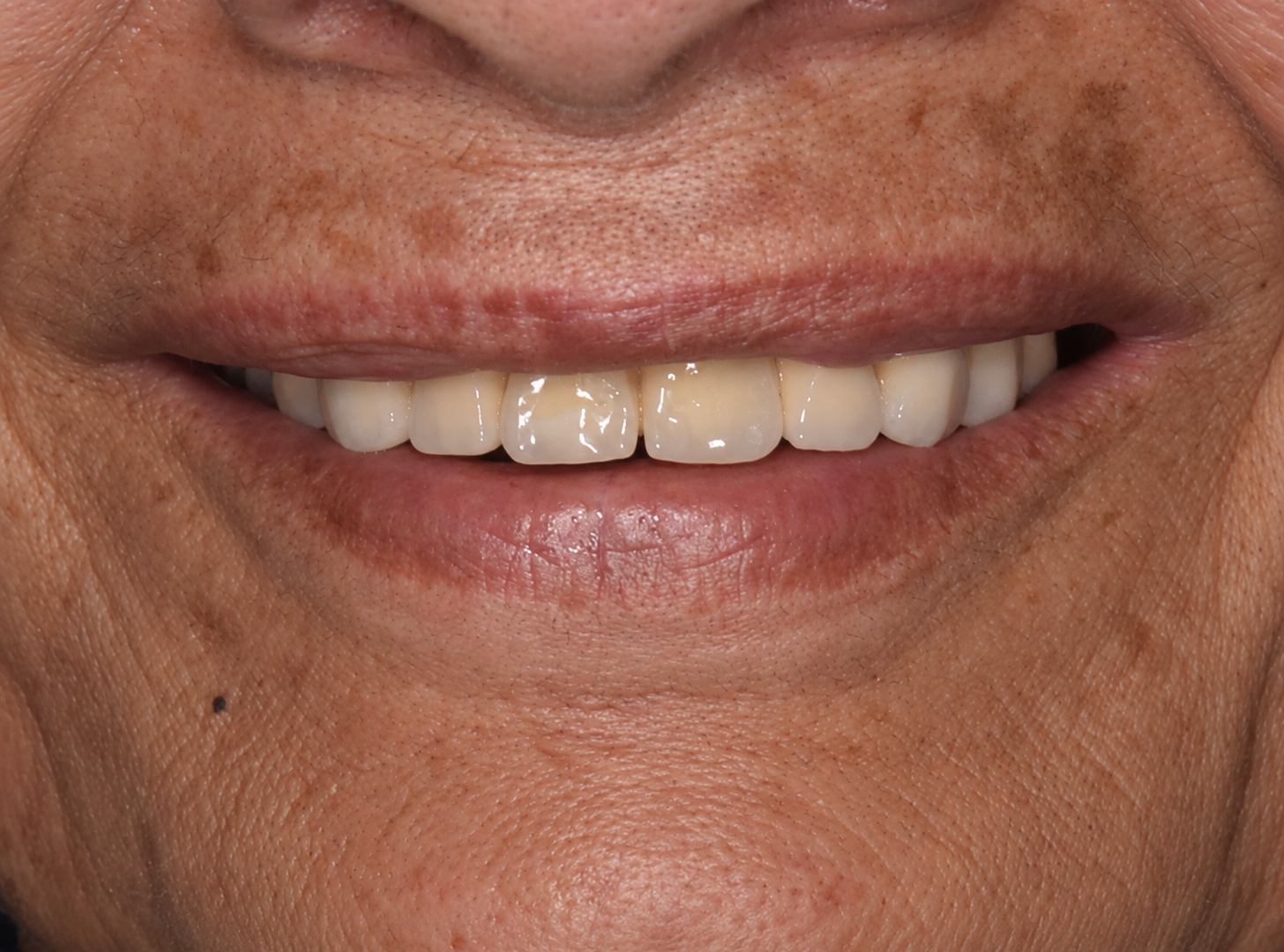 Clinical Close Up Smile Portrait