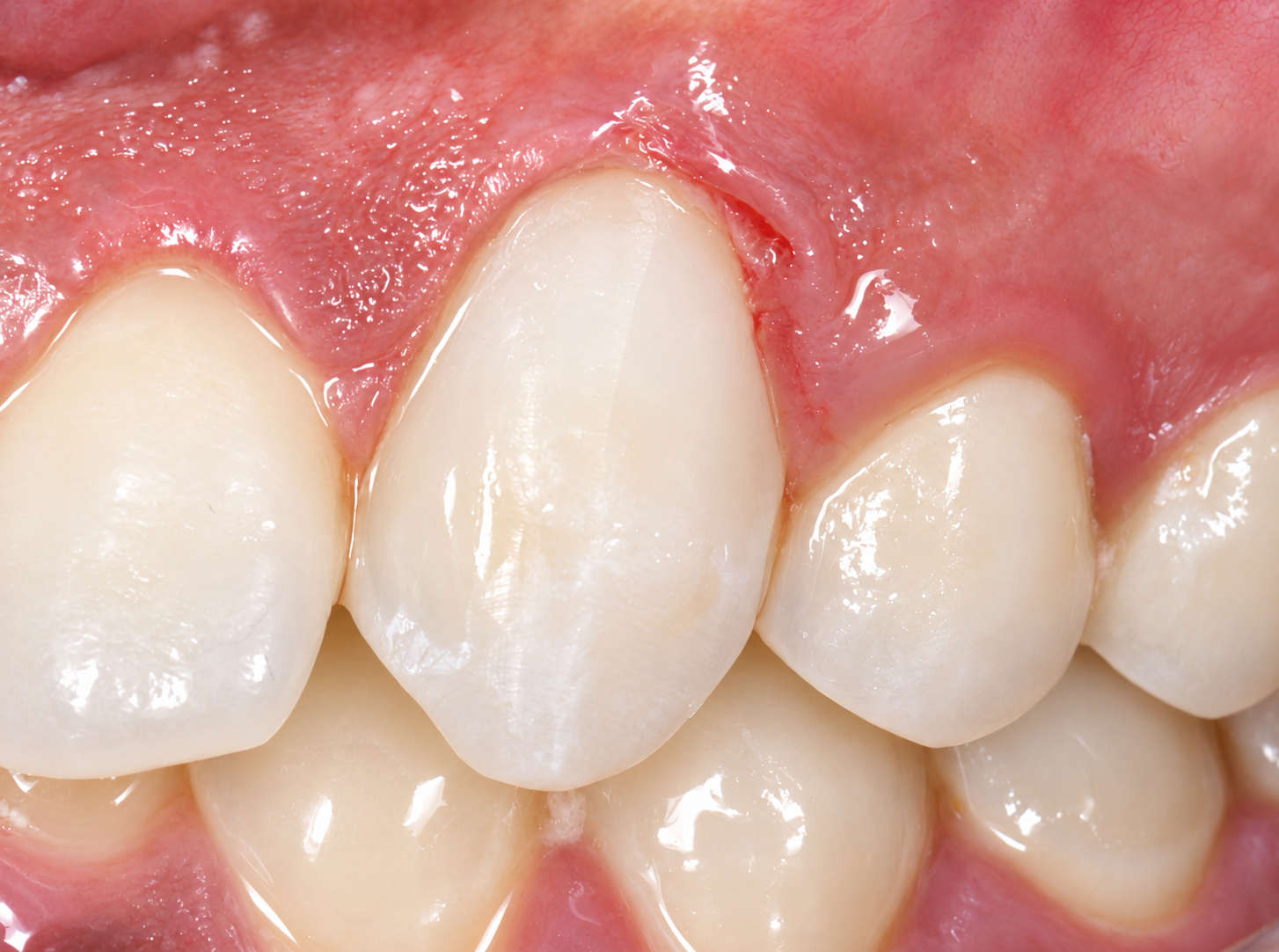Clinical Close Up of Teeth and Gums