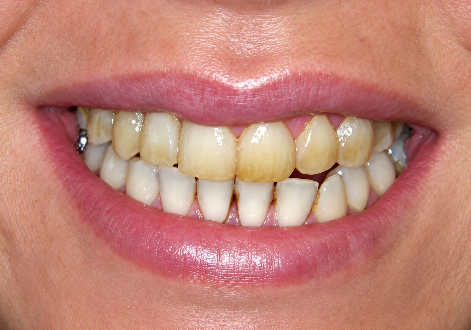 Clinical Close Up of a Natural Smile 1