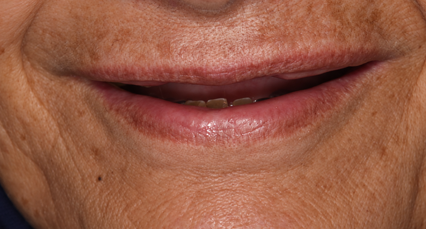Clinical Macro Portrait of an Older Smile 1 e1791027997621