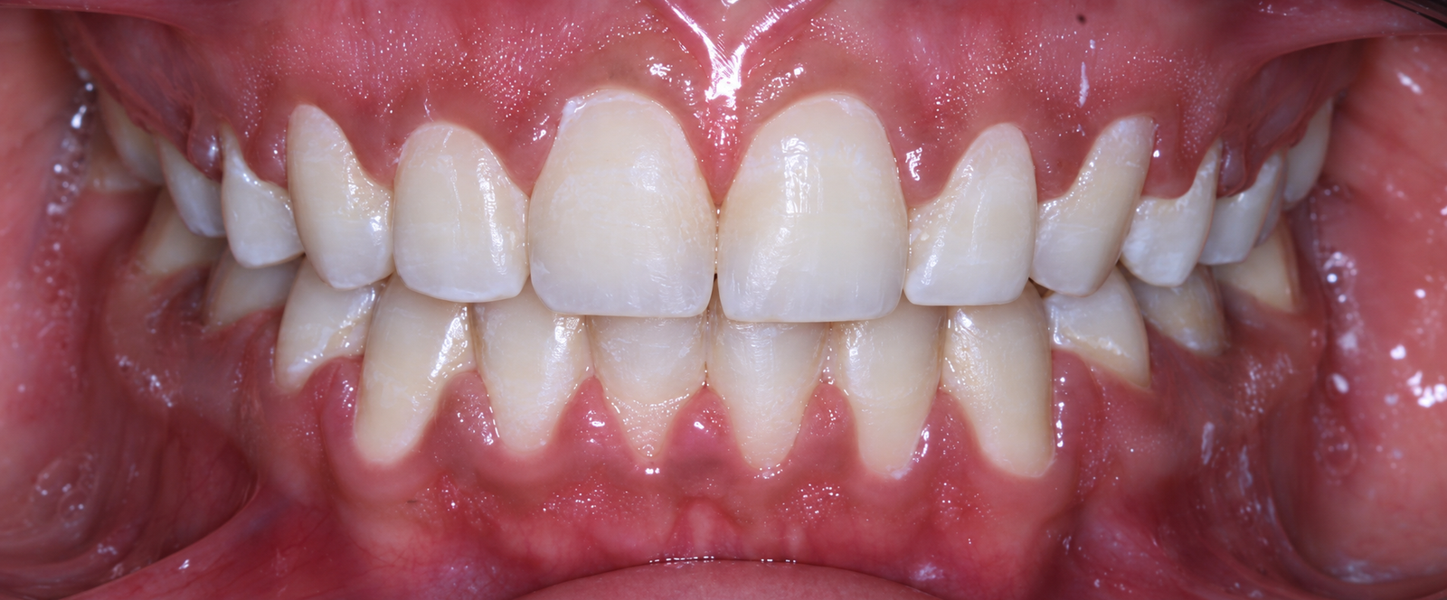 Clinical Portrait of Clean Natural Teeth