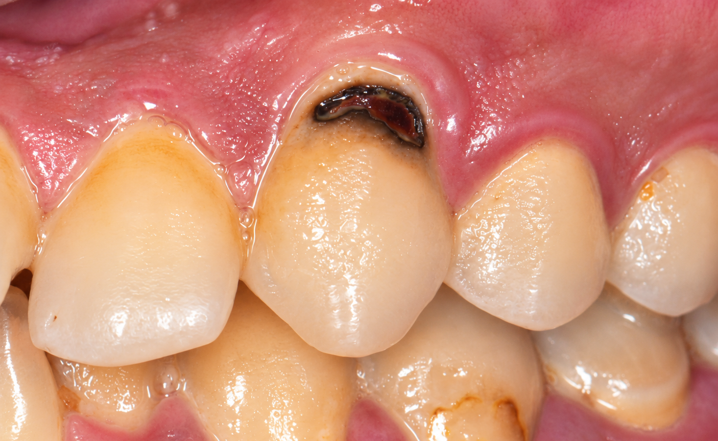 Extreme Close Up of Tooth Decay and Gums 2